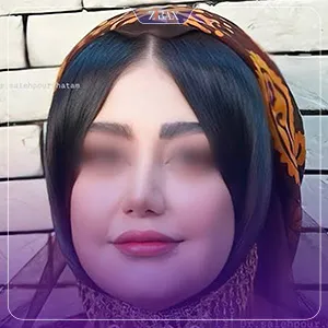 نمونه عمل جراحی بینی دکتر حاتم صالح پور — تصویر 4