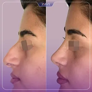 نمونه عمل جراحی بینی دکتر حاتم صالح پور — تصویر 5