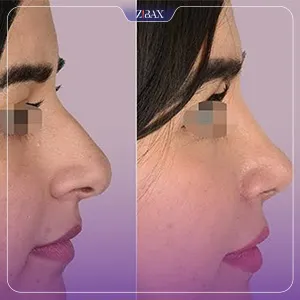 نمونه عمل جراحی بینی دکتر حاتم صالح پور — تصویر 6