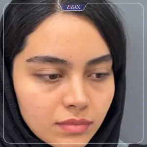 نمونه عمل جراحی بینی دکتر حسام جهاندیده — تصویر 5