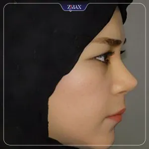نمونه عمل جراحی بینی دکتر هرمز بازیاری دلاور — تصویر 1