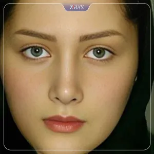 نمونه عمل جراحی بینی دکتر هرمز بازیاری دلاور — تصویر 8