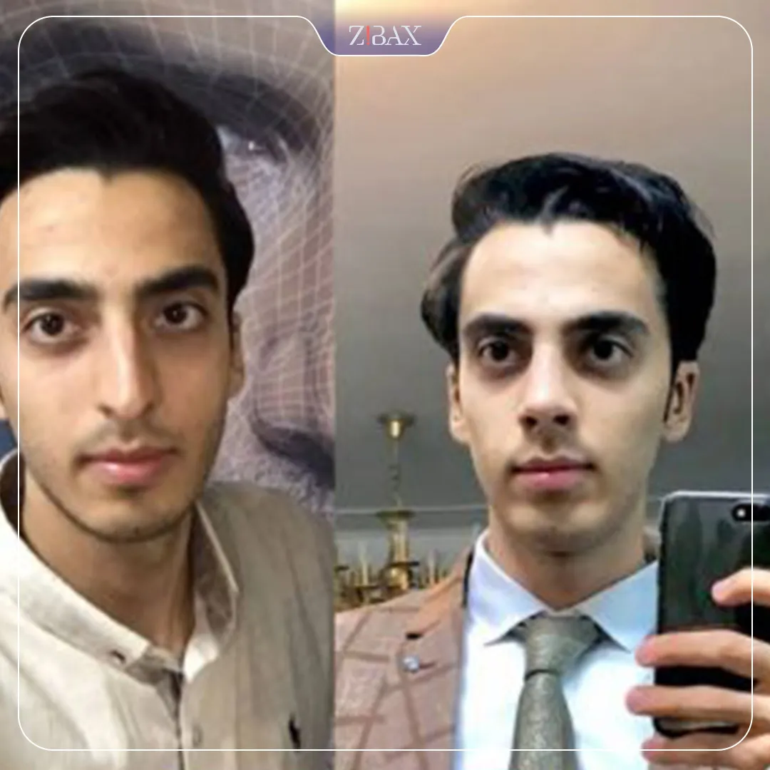 نمونه عمل جراحی بینی دکتر جابر قرشی — تصویر 6