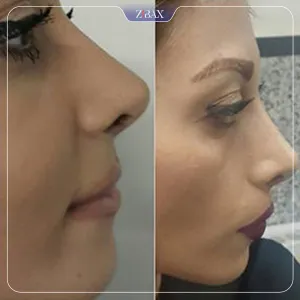 نمونه عمل جراحی بینی دکتر جابر قرشی — تصویر 8