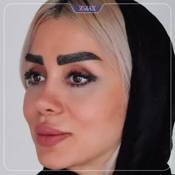 نمونه عمل جراحی بینی دکتر پیمان برومند — تصویر 6