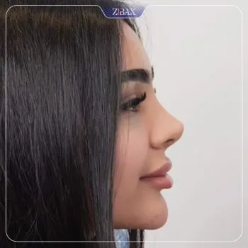 نمونه عمل جراحی بینی دکتر پیمان برومند — تصویر 7