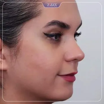 نمونه عمل جراحی بینی دکتر پیمان برومند — تصویر 8
