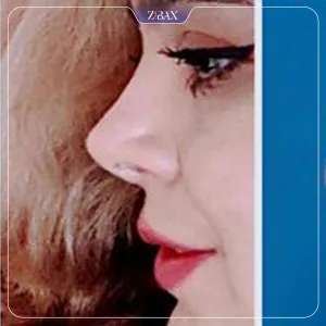 نمونه عمل جراحی بینی دکتر رضا بدیعی — تصویر 3