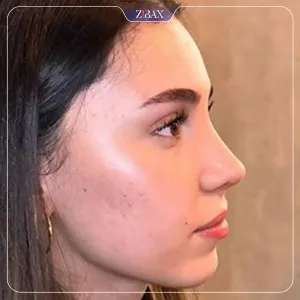 نمونه عمل جراحی بینی دکتر رضا بدیعی — تصویر 2