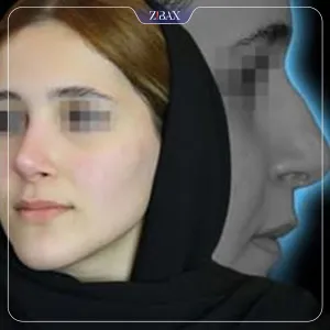 نمونه عمل جراحی بینی دکتر رضا بدیعی — تصویر 7