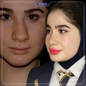 نمونه عمل جراحی بینی دکتر رضا بدیعی — تصویر 5