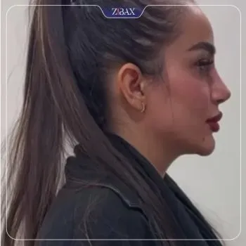 نمونه عمل جراحی بینی دکتر شهره اکرمی ابرقوئ — تصویر 7