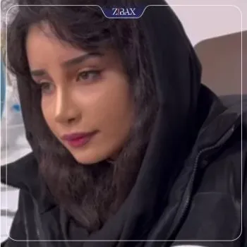 نمونه عمل جراحی بینی دکتر شهره اکرمی ابرقوئ — تصویر 8