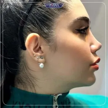 نمونه عمل جراحی بینی دکتر شهره اکرمی ابرقوئ — تصویر 2
