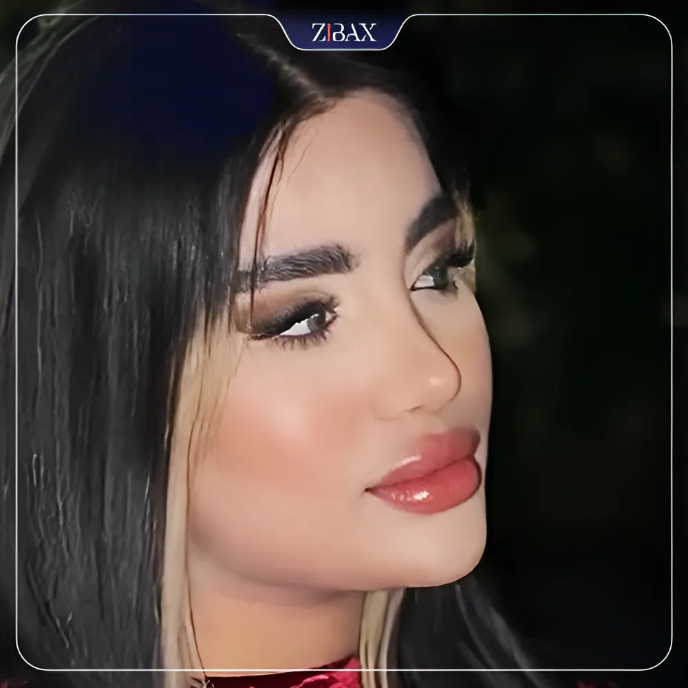 نمونه عمل جراحی بینی دکتر زهرا خسروی — تصویر 10
