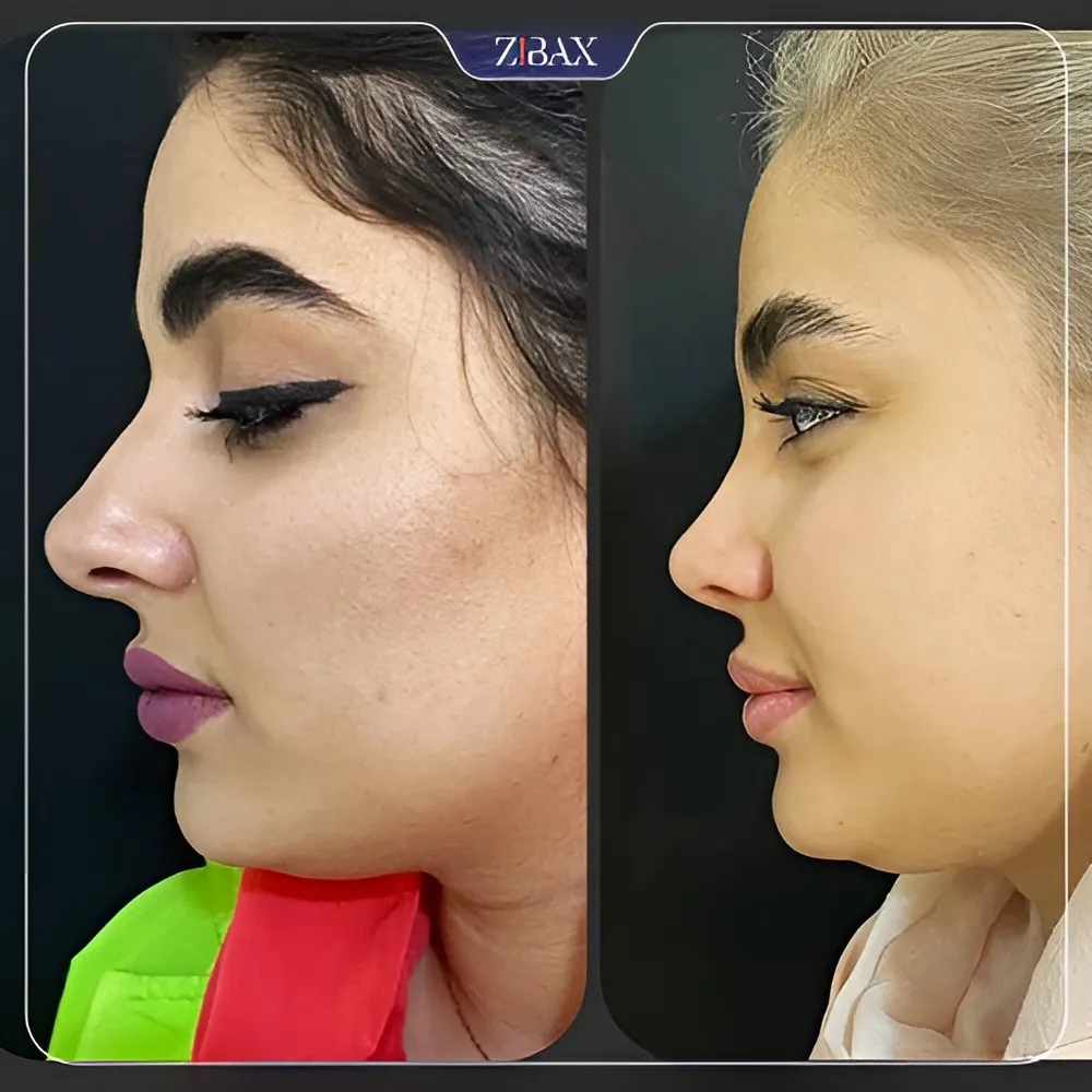 نمونه عمل جراحی بینی دکتر زهرا خسروی — تصویر 2