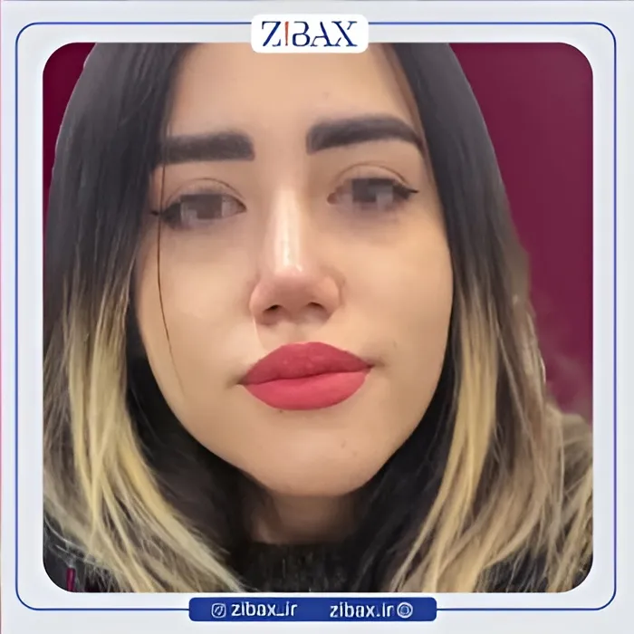 نمونه عمل جراحی بینی دکتر میعاد موسوی — تصویر 9