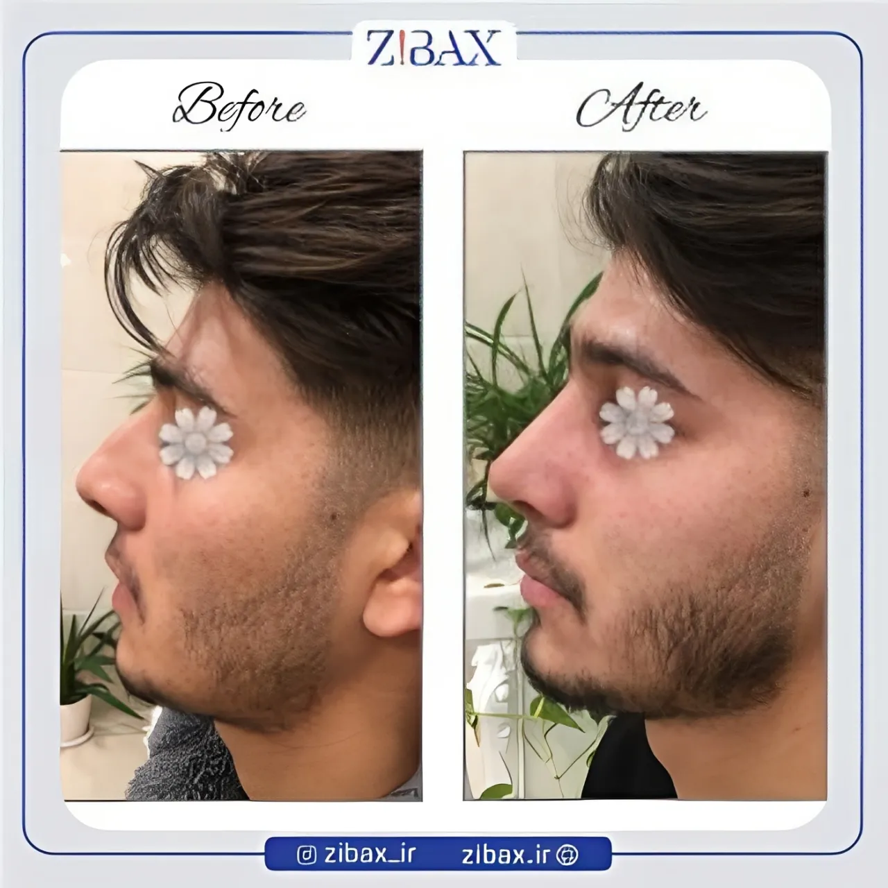 نمونه عمل جراحی بینی دکتر مینا جمالی — تصویر 2