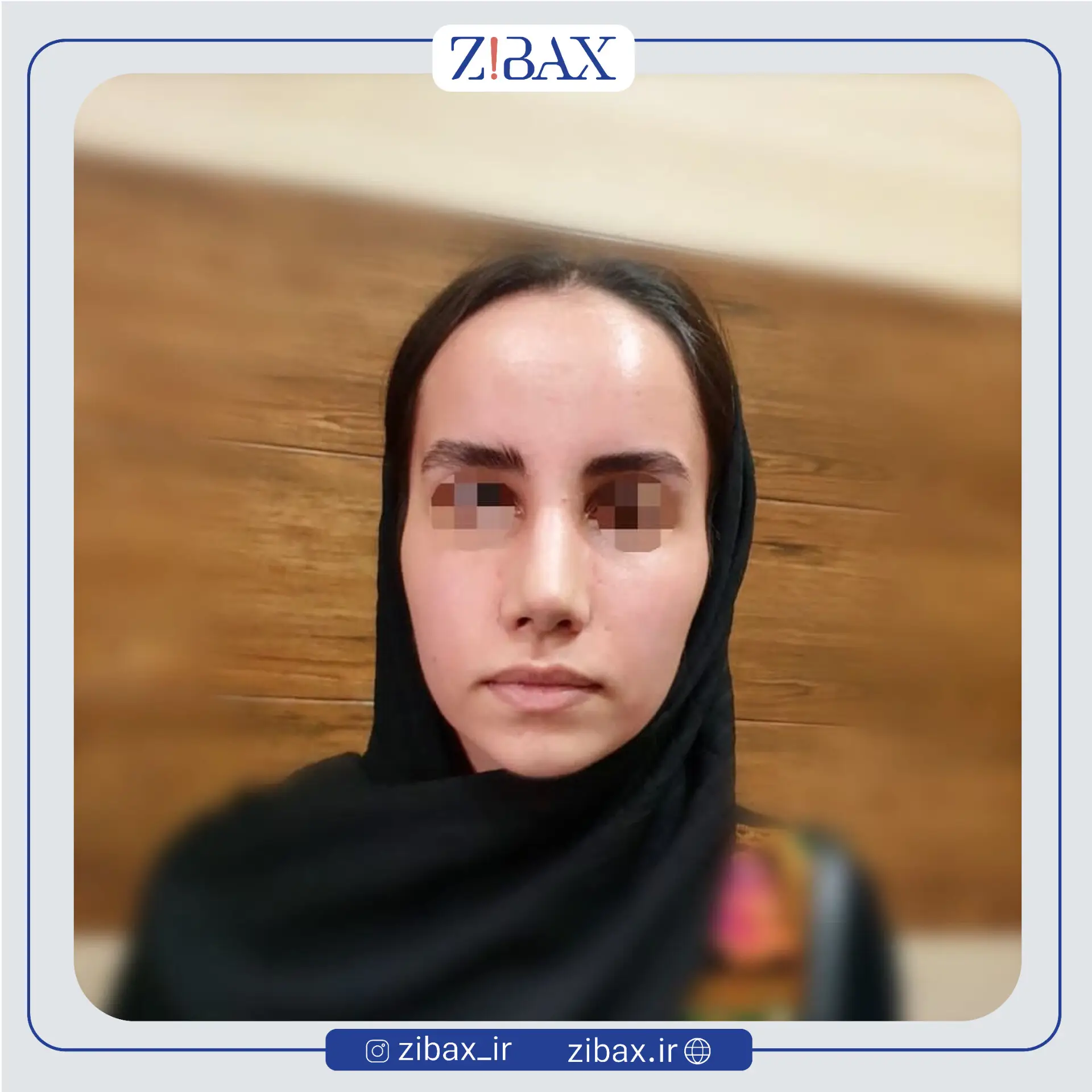 نمونه عمل جراحی بینی دکتر طیبه کاظمی — تصویر 6