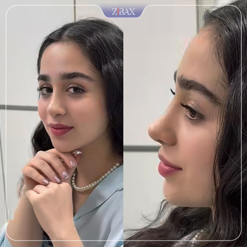 نمونه عمل جراحی بینی دکتر مسعود حسن پور — تصویر 9