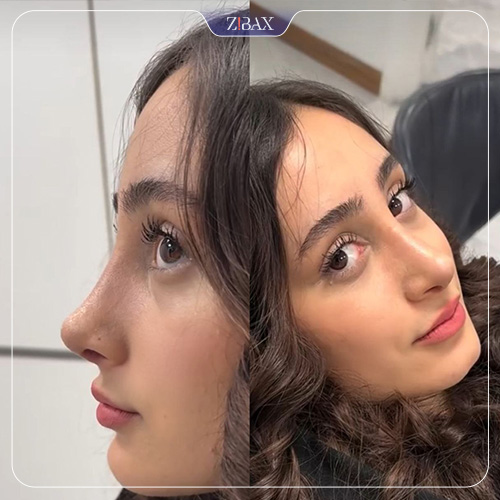 نمونه عمل جراحی بینی دکتر مسعود حسن پور — تصویر 2