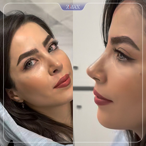 نمونه عمل جراحی بینی دکتر مسعود حسن پور — تصویر 8