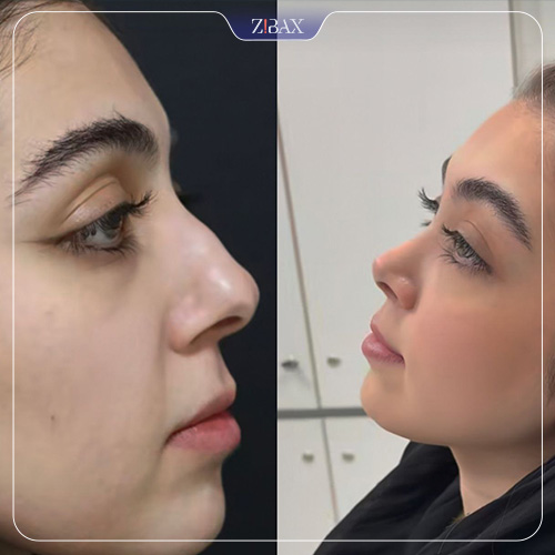 نمونه عمل جراحی بینی دکتر مسعود حسن پور — تصویر 10