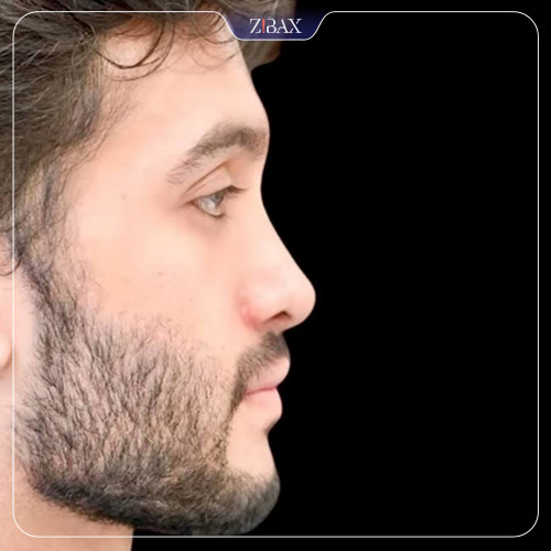 نمونه عمل جراحی بینی دکتر حامد محمدی — تصویر 17