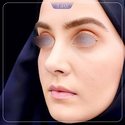 نمونه عمل جراحی بینی دکتر حامد محمدی — تصویر 19