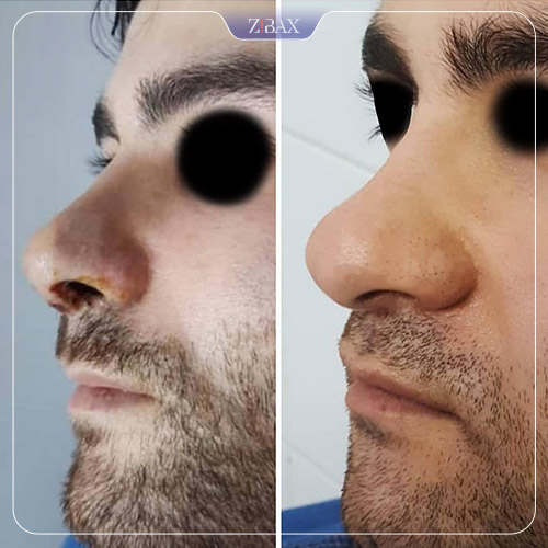 نمونه عمل جراحی بینی دکتر حشمت الله حقوقی — تصویر 1