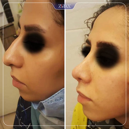 نمونه عمل جراحی بینی دکتر حشمت الله حقوقی — تصویر 2