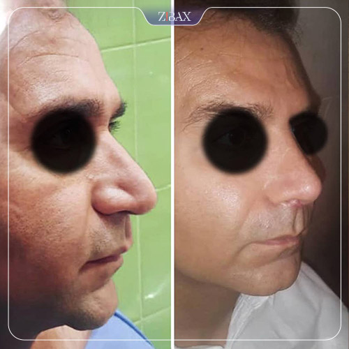 نمونه عمل جراحی بینی دکتر حشمت الله حقوقی — تصویر 3