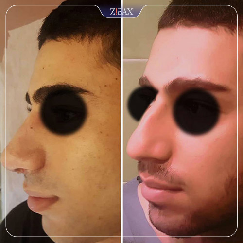 نمونه عمل جراحی بینی دکتر حشمت الله حقوقی — تصویر 4