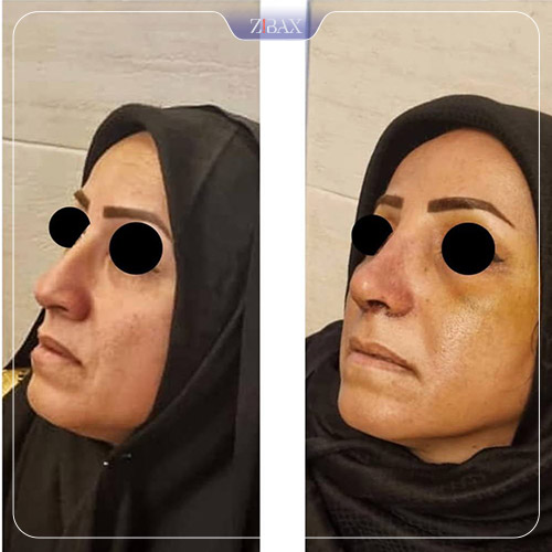 نمونه عمل جراحی بینی دکتر حشمت الله حقوقی — تصویر 6