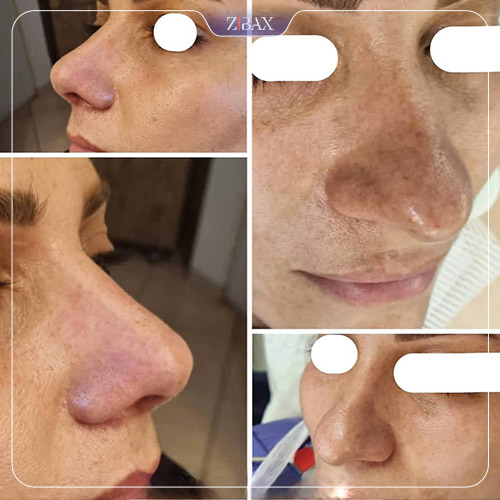 نمونه عمل جراحی بینی دکتر حشمت الله حقوقی — تصویر 7