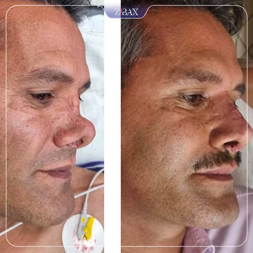 نمونه عمل جراحی بینی دکتر حشمت الله حقوقی — تصویر 8