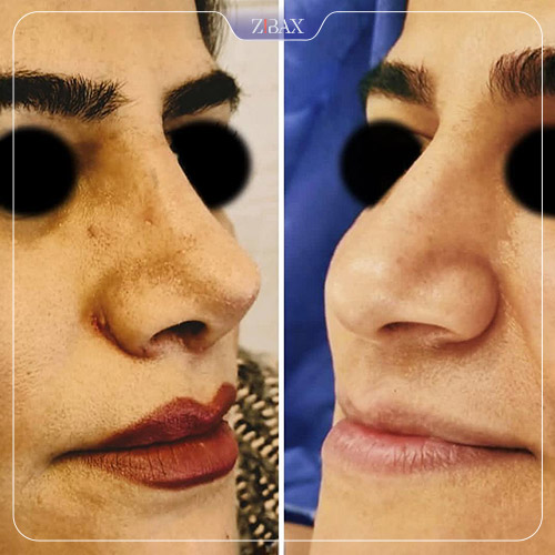 نمونه عمل جراحی بینی دکتر حشمت الله حقوقی — تصویر 9