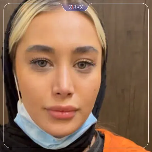 نمونه عمل جراحی بینی دکتر بهرام مقدم فرد — تصویر 7