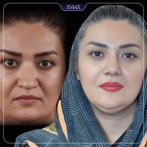 نمونه عمل جراحی بینی دکتر علیرضا مزارعی — تصویر 3