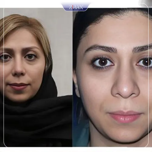 نمونه عمل جراحی بینی دکتر علیرضا مزارعی — تصویر 2