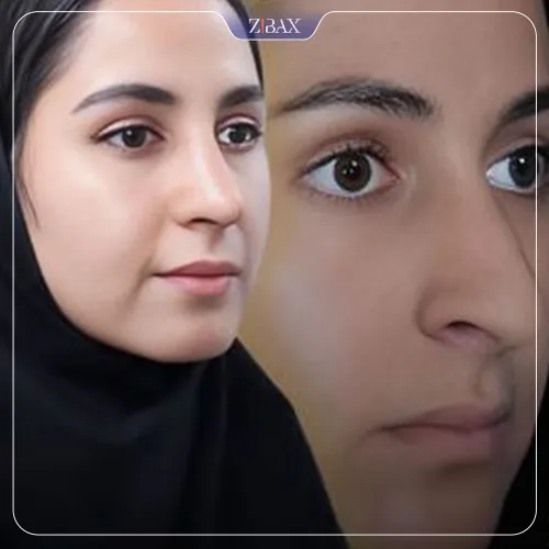 نمونه عمل جراحی بینی دکتر علیرضا مزارعی — تصویر 1