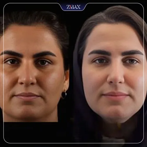 نمونه عمل جراحی بینی دکتر علیرضا مزارعی — تصویر 8