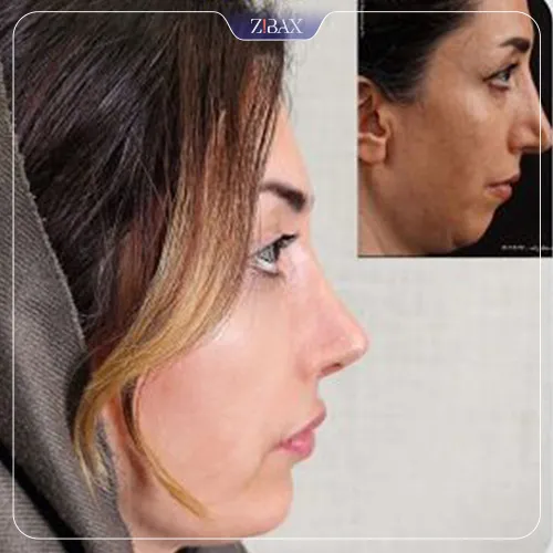 نمونه عمل جراحی بینی دکتر علیرضا مزارعی — تصویر 7