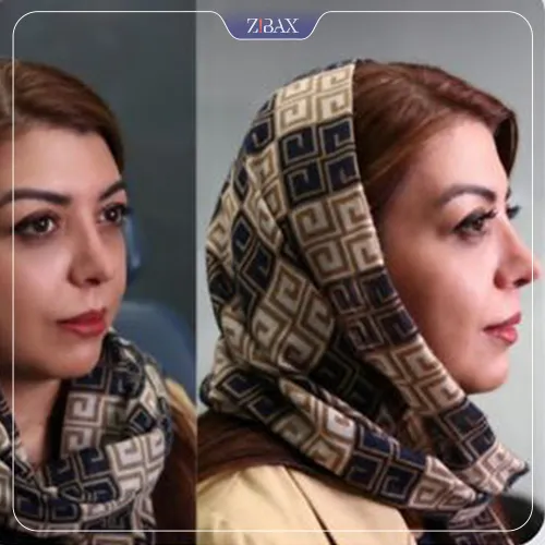 نمونه عمل جراحی بینی دکتر علیرضا مزارعی — تصویر 6
