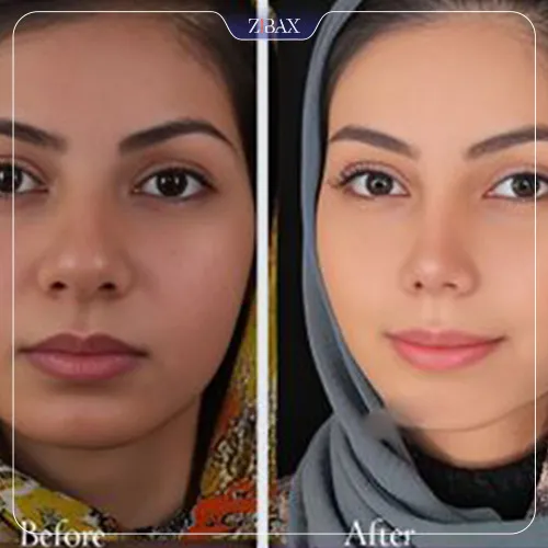 نمونه عمل جراحی بینی دکتر پارسا چراغی پور — تصویر 7