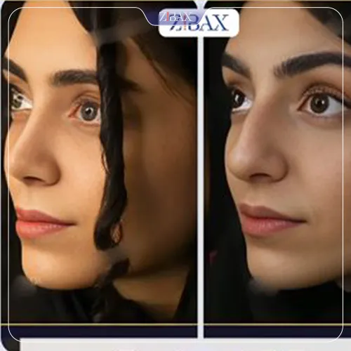 نمونه عمل جراحی بینی دکتر پارسا چراغی پور — تصویر 8
