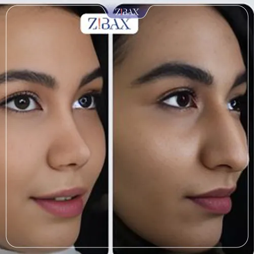 نمونه عمل جراحی بینی دکتر پارسا چراغی پور — تصویر 1
