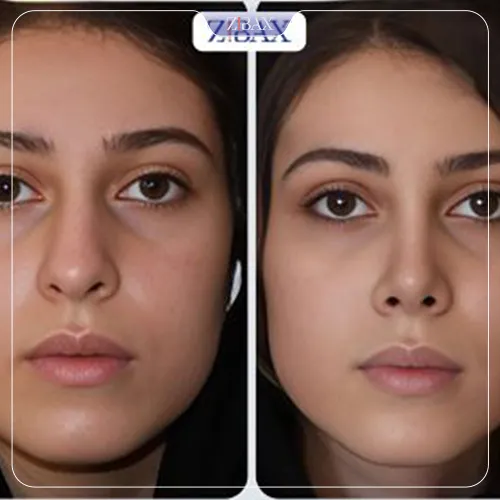 نمونه عمل جراحی بینی دکتر پارسا چراغی پور — تصویر 2