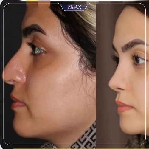نمونه عمل جراحی بینی دکتر پارسا چراغی پور — تصویر 4