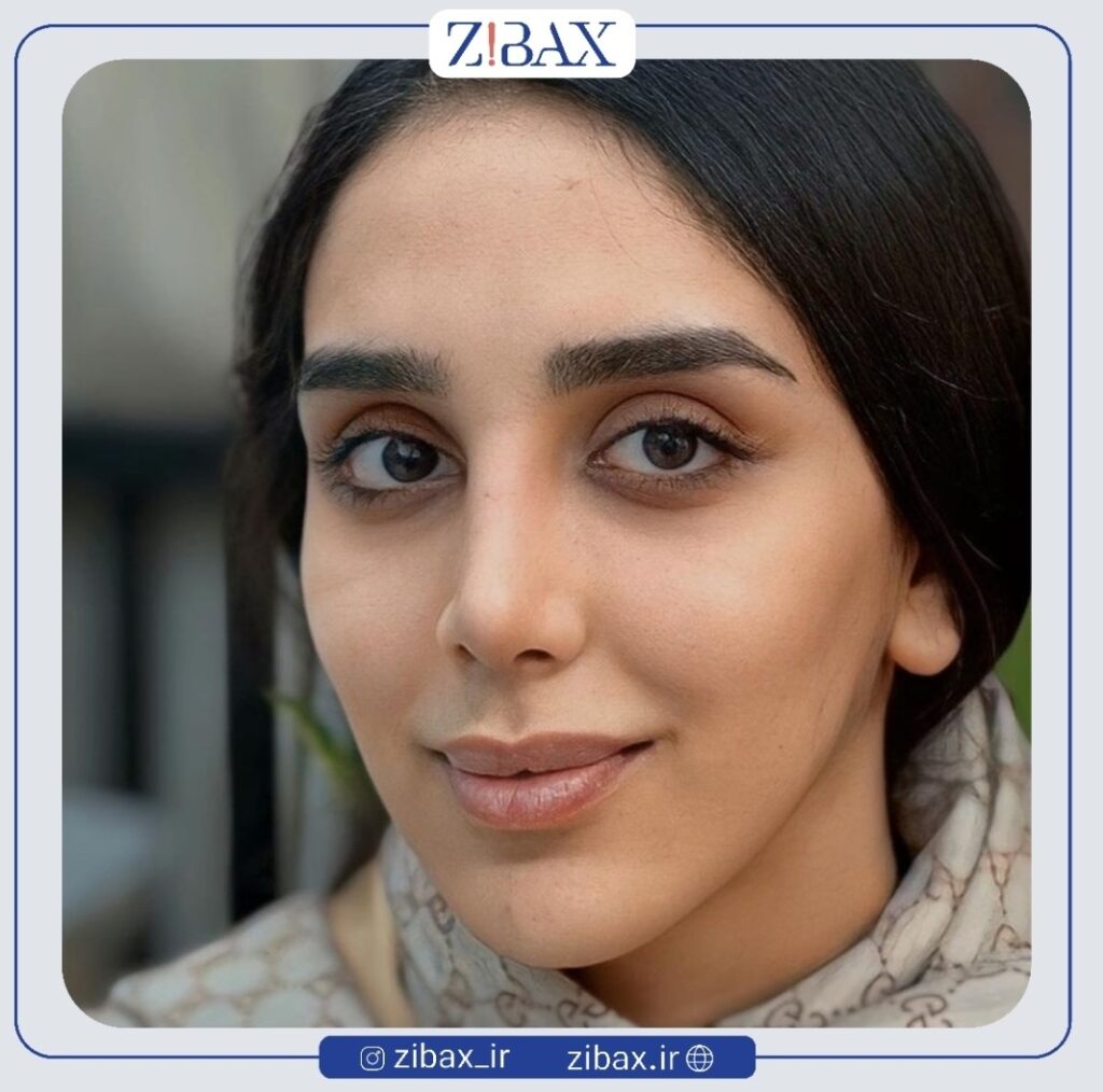نمونه عمل بینی طبیعی در تهران با مشاوره زیباکس